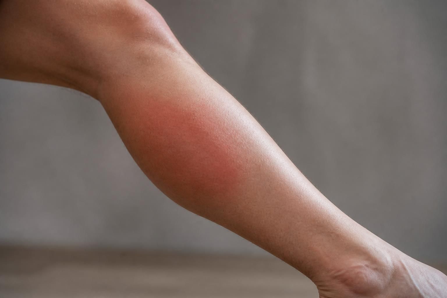 découvrez comment reconnaître les symptômes de la phlébite, notamment la douleur au mollet ou à la jambe, pour agir rapidement et prévenir les complications.