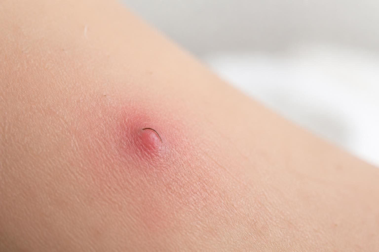 découvrez comment identifier et traiter efficacement les poils sous peau, un problème courant des poils incarnés, avec nos conseils pratiques pour une peau saine et sans irritation.